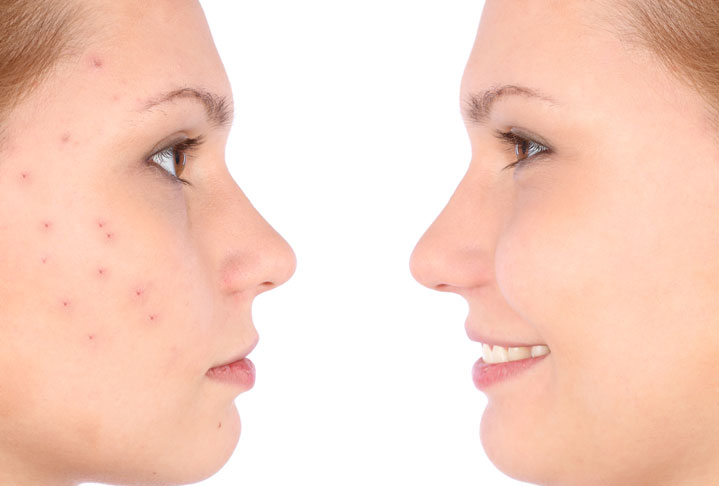 Before and After portrait image of woman with and without acne